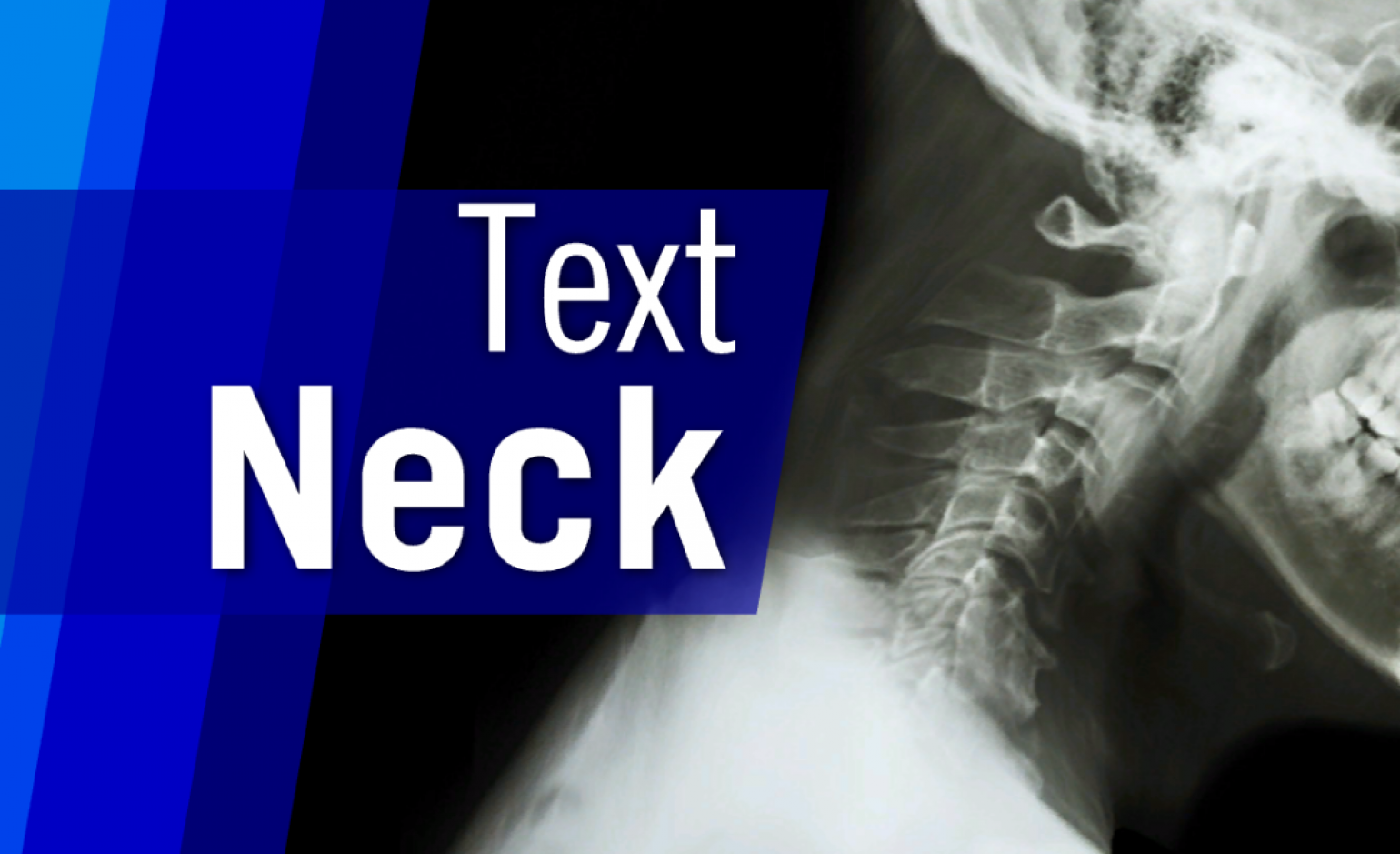 Break a neck odetari. Text Neck Syndrome. Text Neck.